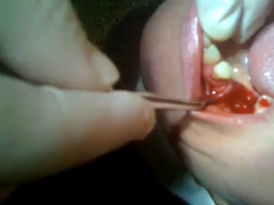 extraction dentaire classique