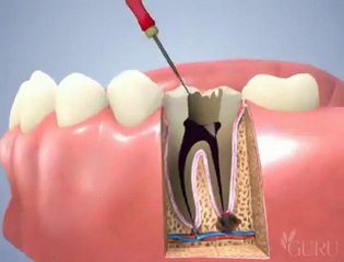 traitement canalaire après devitalisation