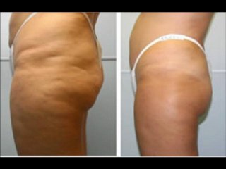 Celulitis Nunca Mas... Sepa sus causas y como eliminarlas naturalmente 100% efectivo