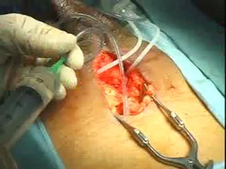 COLOPLAST 3 PARÇA PENİS PROTEZ Infrapubic approach