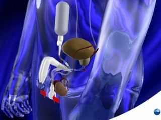 COLOPLAST 3 PARÇA PENİS PROTEZ Patient Educational Video