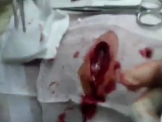 فري برس ادلب التمانعة احدى الاصابات جراء القصف الاسدي على البلدة 7 5 2012 Idlib