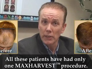 Steve Cook Welcome's You To Great Hair Transplants