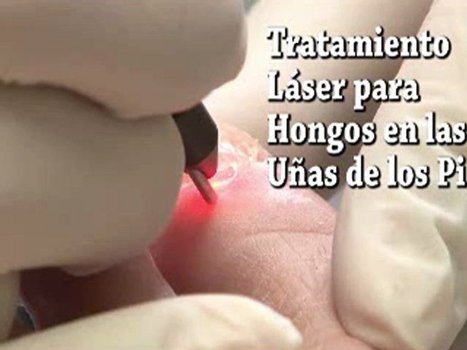 Láser para Hongos en las Uñas de los Pies - Podólogo en NYC Manhattan y White Plains, NY