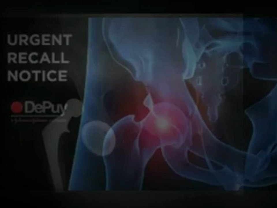 Our Lawyers will help you file for a Depuy Hip Recall Lawsuit