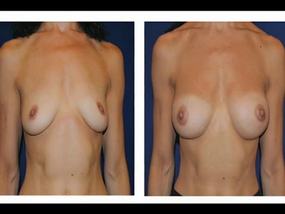 Mommy Makeover NYC Dr. Keegan Speaks About Breast Augmentation