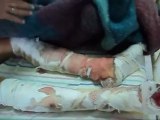 فري برس  حلب جسد أحد الجرحى تظهر فيه شظايا قذيفة دبابة 11 5 2012 Aleppo