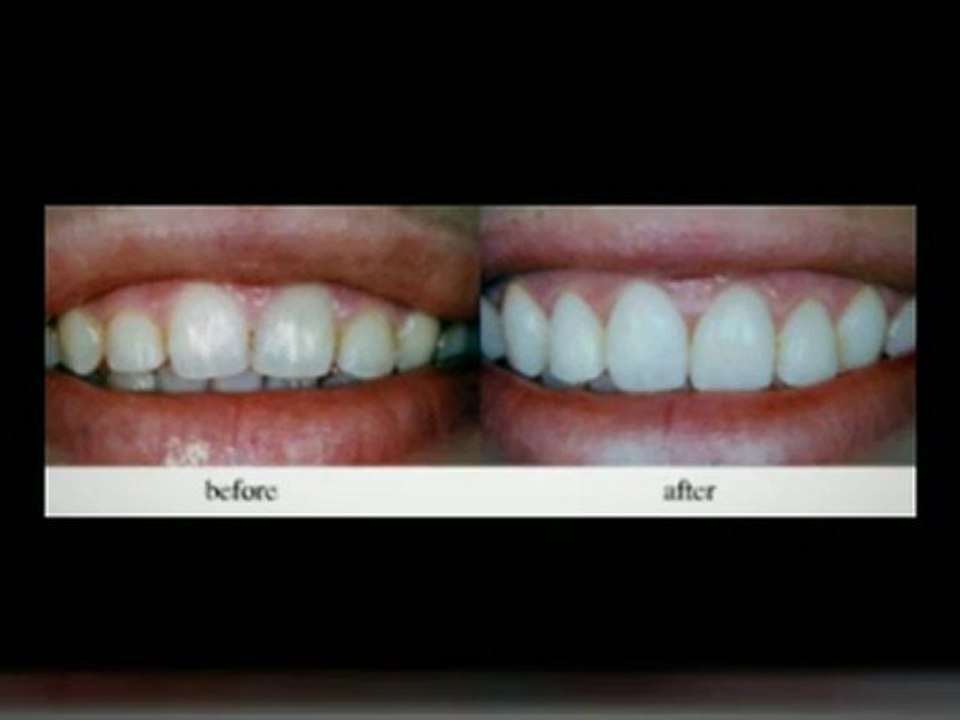 Dental Implants Las Vegas