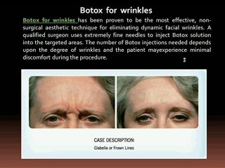 Botox for migraines