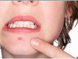 Effective Pimple Remedies for Clear Skin ✨