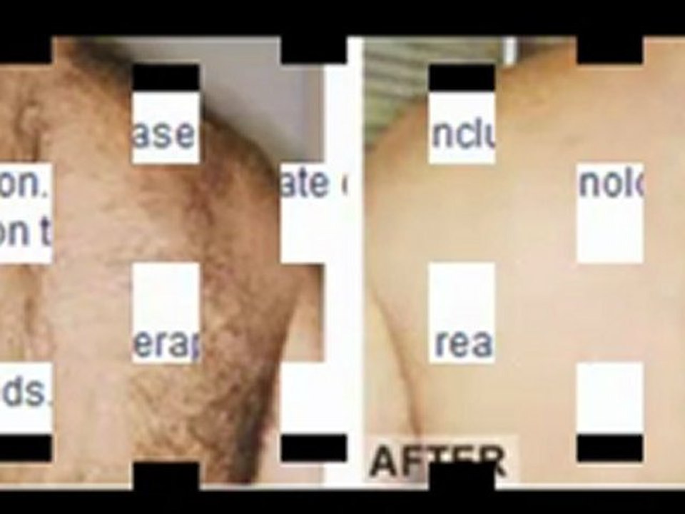 Sydney Laser Hair Removal