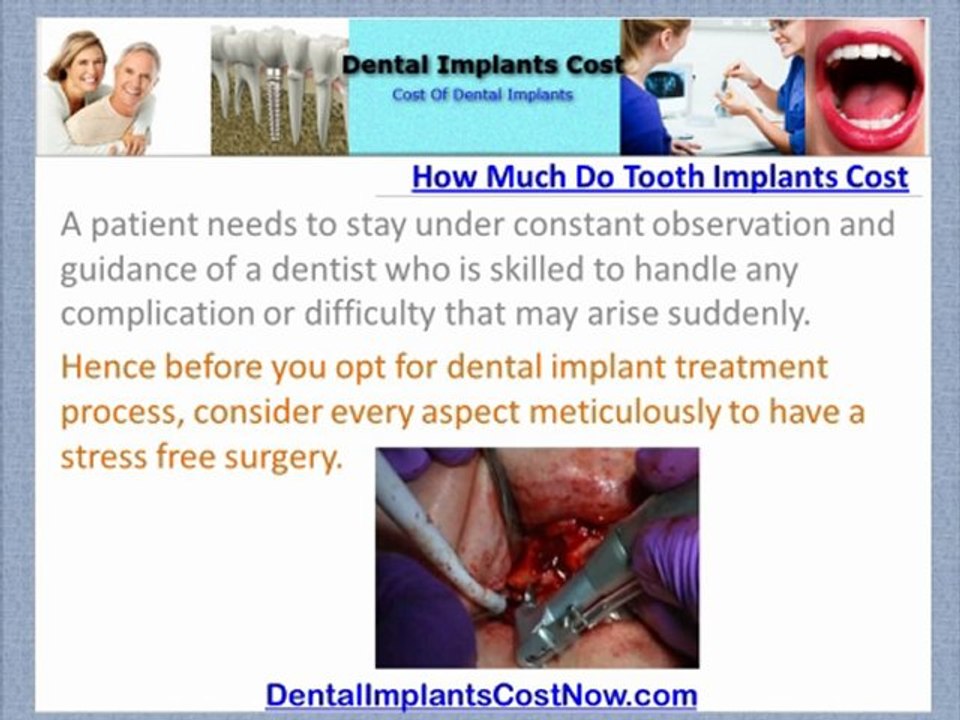 [How Much Do Tooth Implants Cost]