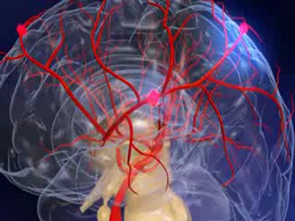 001-Accidents-vasculaires-cerebraux