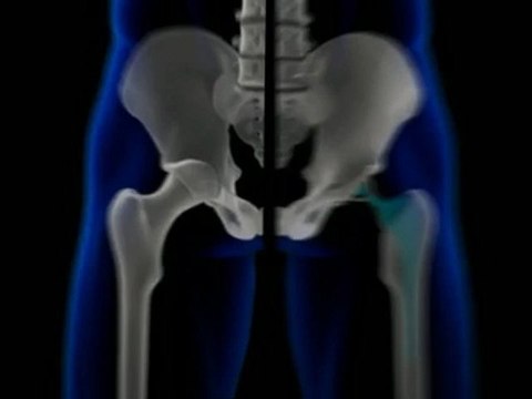 Hip Replacement Lawyers Aid Patients Affected by DePuy Recall