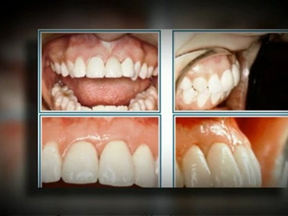 Dental Implants Washington DC