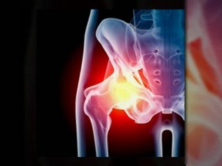 Are You filing for a Depuy Hip Recall Lawsuit?