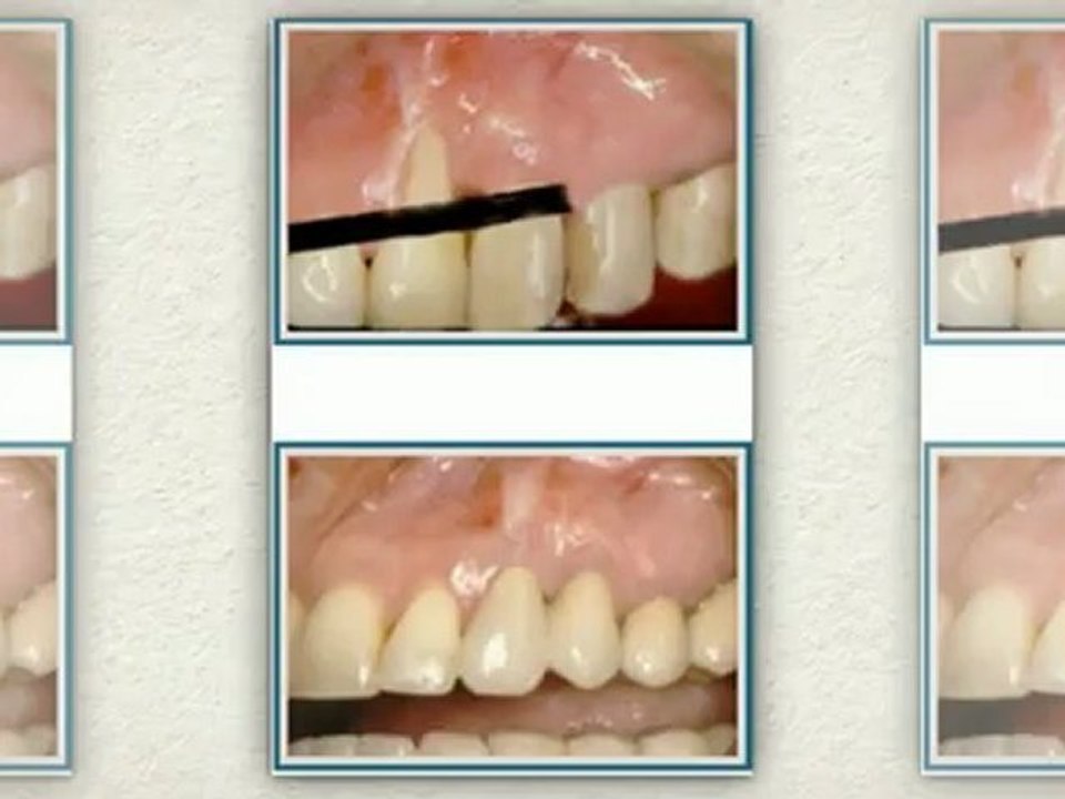 Dental Implants Washington DC