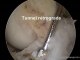 Rupture partielle du ligament croisé antérieur,  technique de ligamentoplastie  anatomique  tls uni-fasciculaire  par  réparation du faisceau antéro-médial.