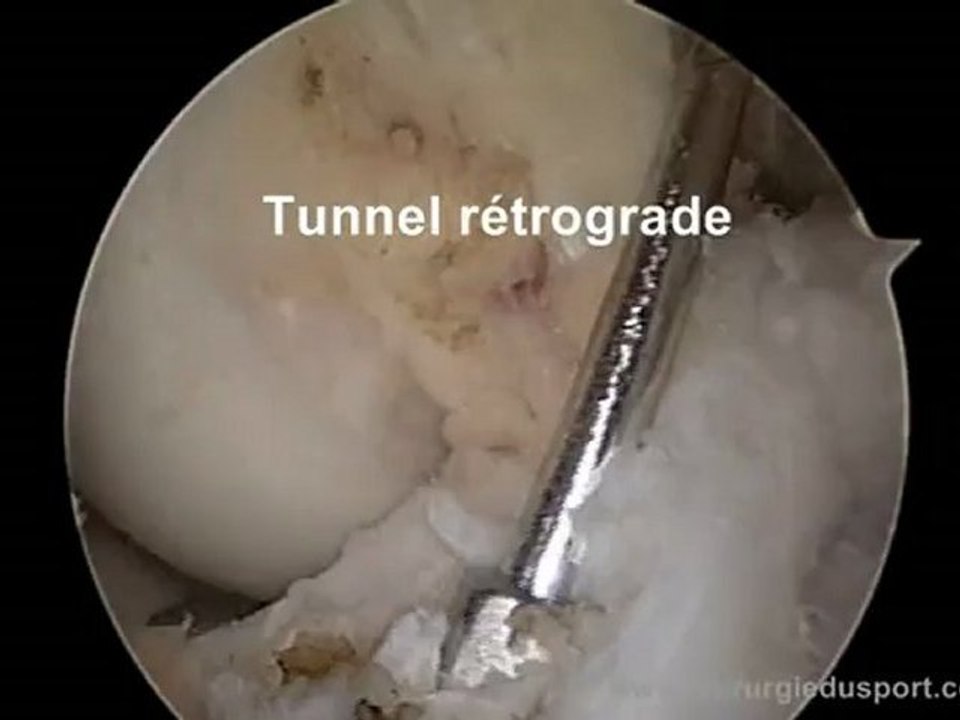 Rupture partielle du ligament croisé antérieur,  technique de ligamentoplastie  anatomique  tls uni-fasciculaire  par  réparation du faisceau antéro-médial.