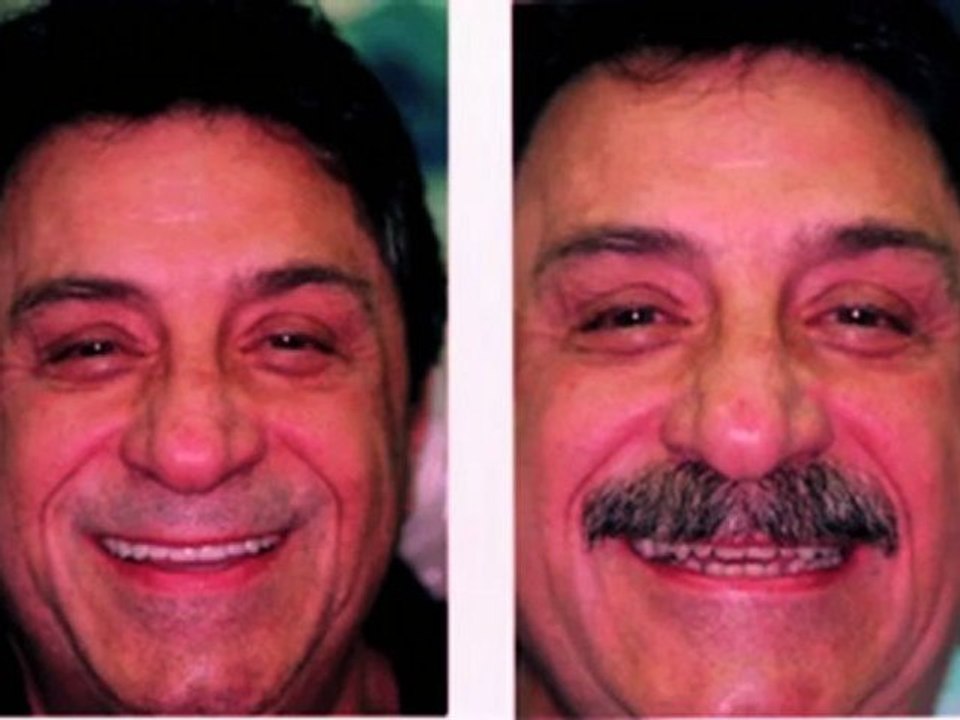 ed gets veneers