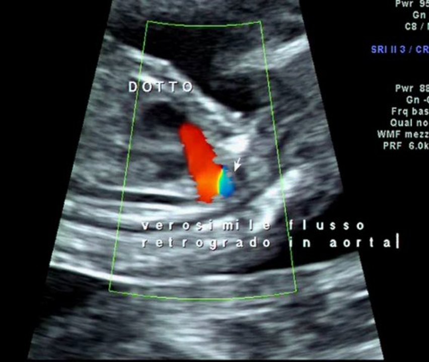 Cuore sinistro ipoplasico