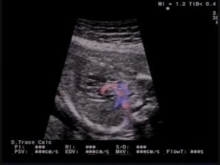 Cuore sinistro ipoplasico e persistenza della vena cava superiore sinistra