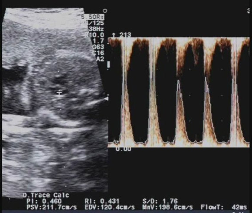 Cuore destro ipoplasico