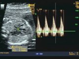 Stenosi aortica e persistenza della vena cava superiore sinistra