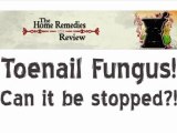 Home Remedies for Toenail Fungus