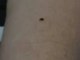 Feeding a Bed Bug | Pic of Bed Bugs | Bed Bug Pictures