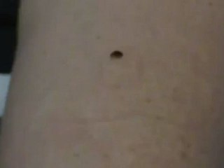 Feeding a Bed Bug | Pic of Bed Bugs | Bed Bug Pictures