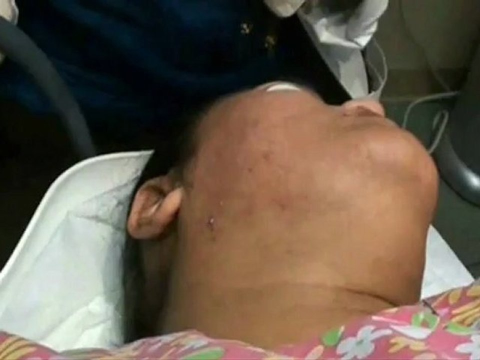 how to extract and control acne, blackhead effectively