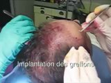 Micro-greffes cheveux FUE à Paris : opération la chute et perte des cheveux - Dr Montoneri