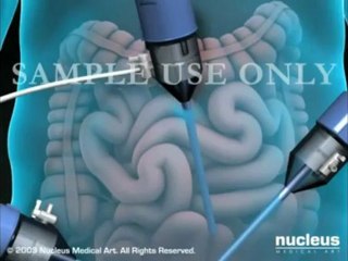 Treating Hernia with Laparscopic Inguinal Hernia Repair