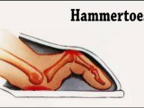 Hammertoes - Podiatrist - Kansas City, MO - Overland Park, KS - Thomas Bembynista, DPM