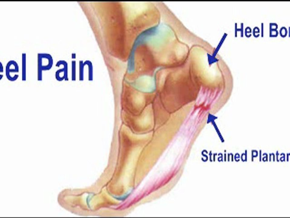 Heel Pain Treatment - Kansas City, MO and Overland Park, KS - Podiatrist