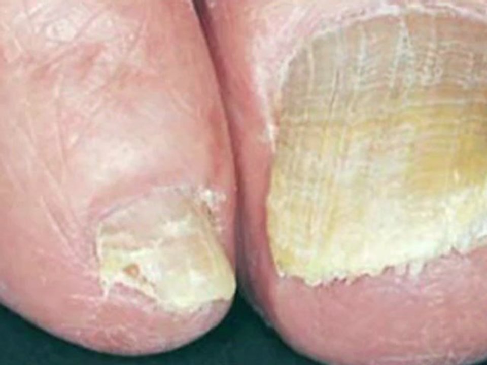 Laser  Fungal Toenails - Kansas City, MO and Overland Park, KS - Podiatrist