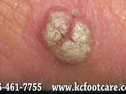 Foot Warts - Podiatrist in Kansas City, MO and Overland Park, KS -