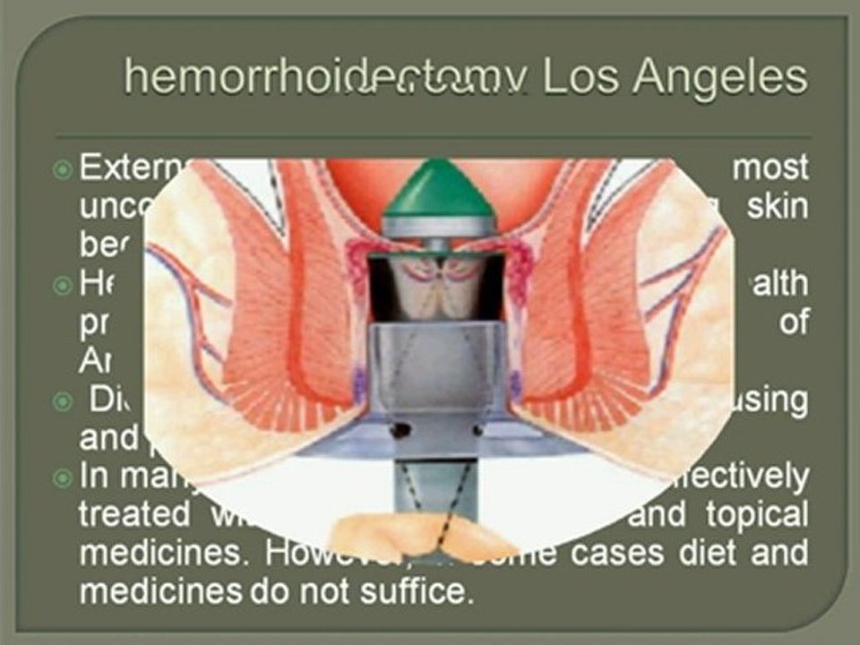 BENEFITS OF HEMORRHOID SURGERY