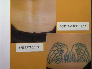 Dr. Eric Seiger: Laser Tattoo Removal