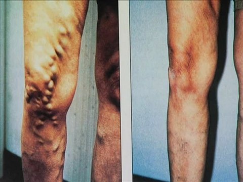 Dr. Eric Seiger: varicose Vein in MI