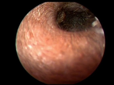 Un insecte dans l'oreille