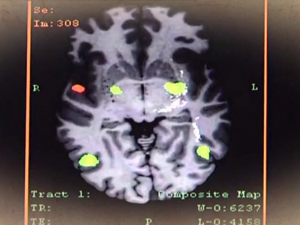 Estimulacio cognitiva i plasticitat cerebral