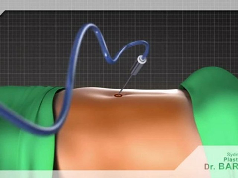 Liposuction Sydney Australia. Dr Barnouti