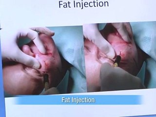 Face Lift, Nose Job, Rhinoplasty, Fat injection by Dr Barnouti.