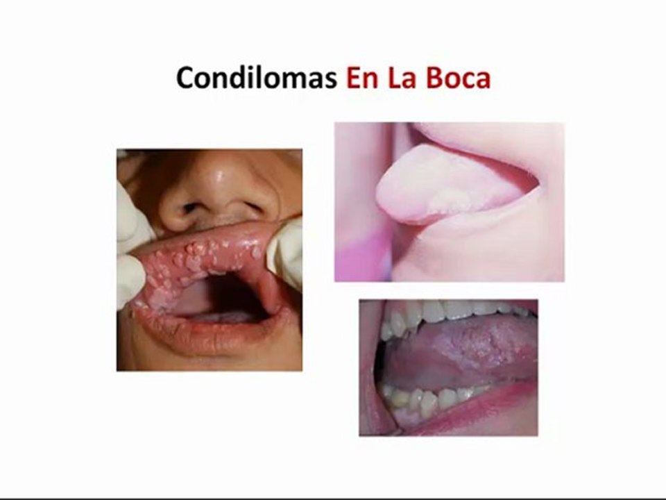 El Condiloma En La Boca