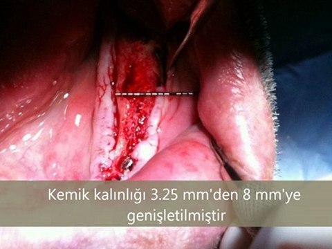 İmplant Diş Tedavisi ; Alt çenede ince kemiğe implant ameliyatı , implant video , implant diş ameliyatı izle