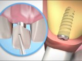 İmplant diş ameliyatı nasıl yapılır ? implant  videoları , diş implantı ameliyatı , implant diş nasıl yapılır