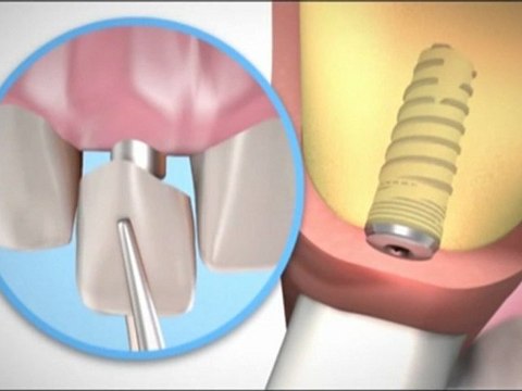 İmplant diş ameliyatı nasıl yapılır ? implant videoları , diş implantı ameliyatı , implant diş nasıl yapılır