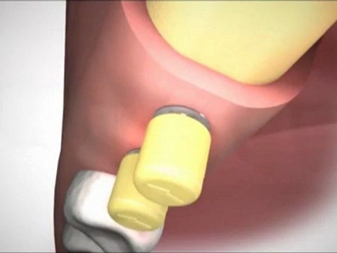 İMPLANT TEDAVİSİ Mİ ? DİŞ KÖPRÜ TEDAVİSİ Mİ ? implant diş videoları izle